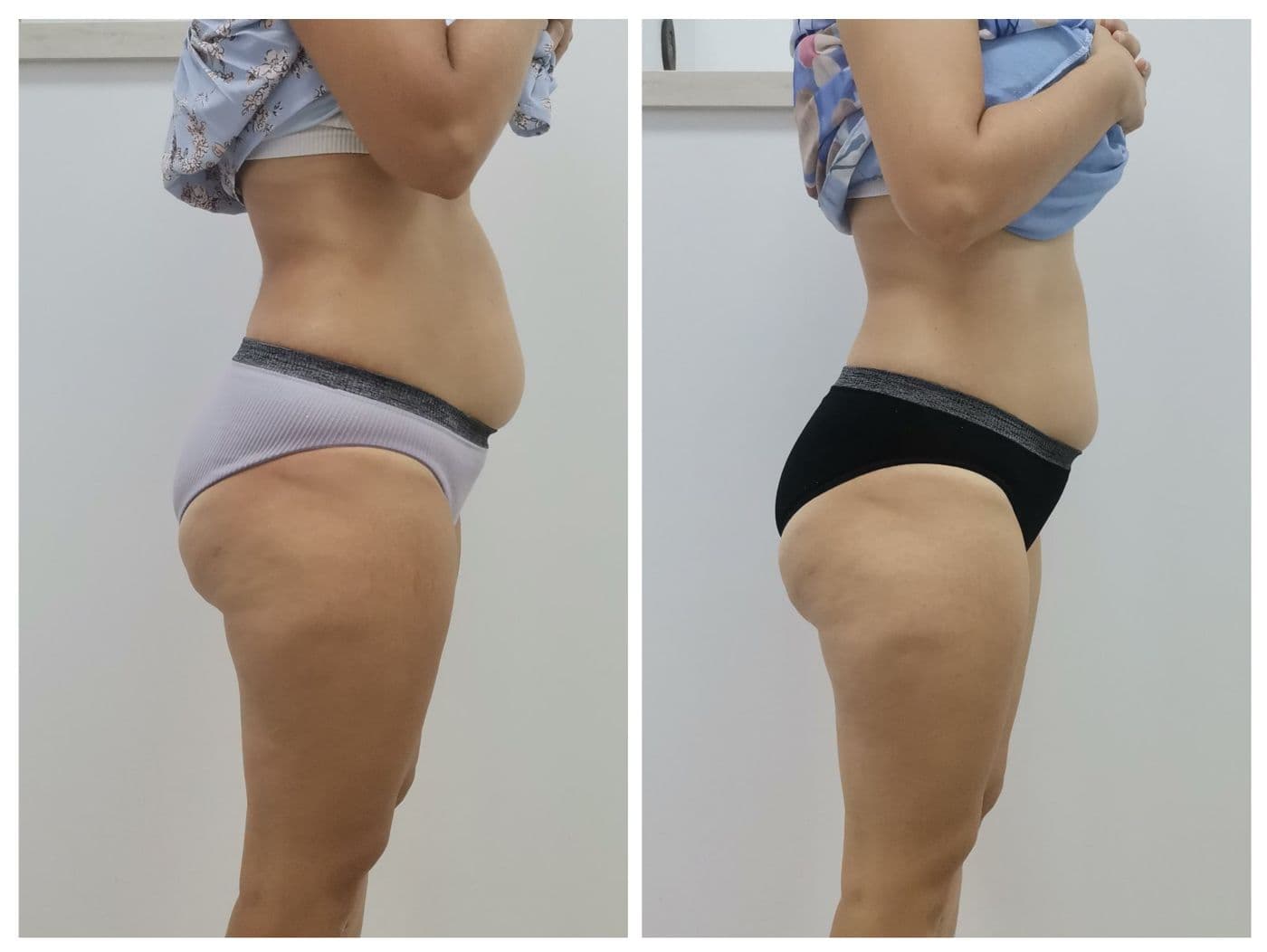 Sculpt Pro и пресотерапия: преди и след