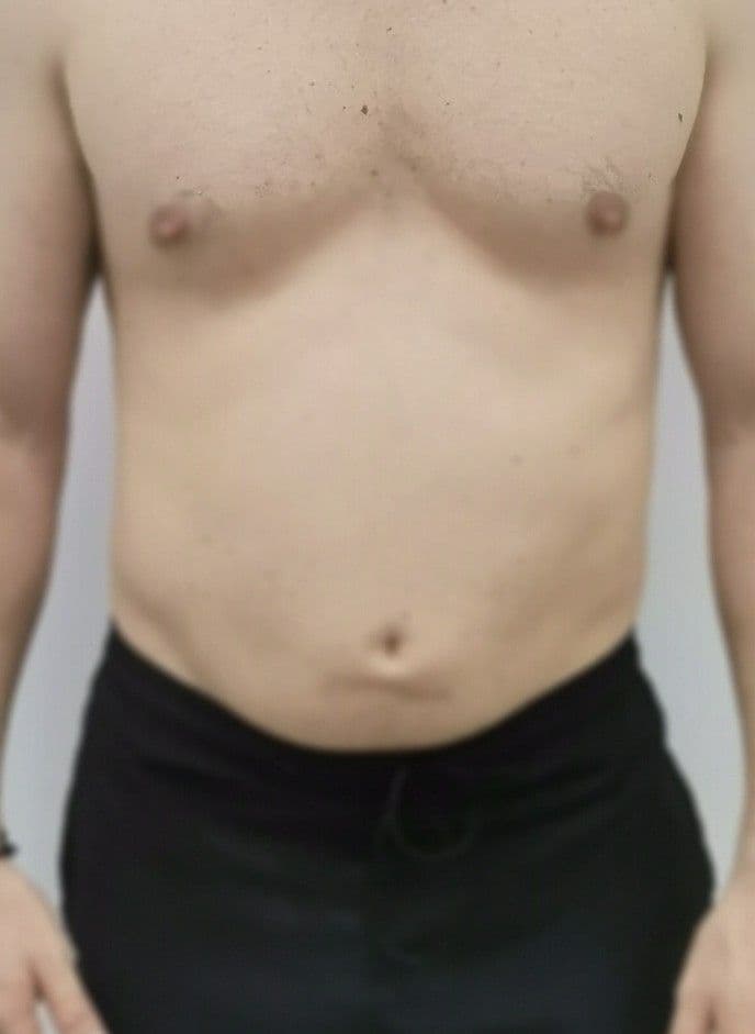 Sculpt Pro и пресотерапия: преди и след