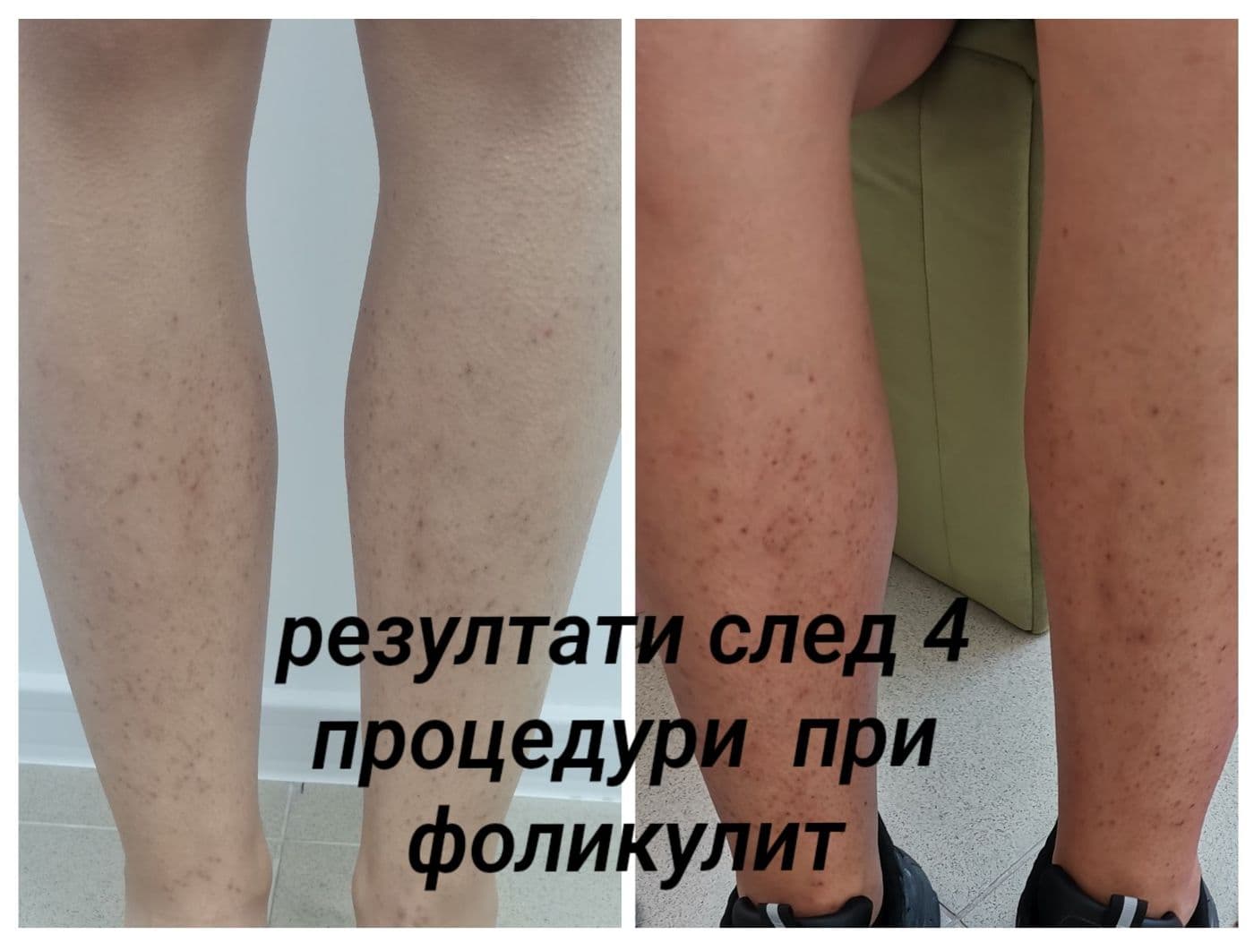 Лазерна епилация: преди и след
