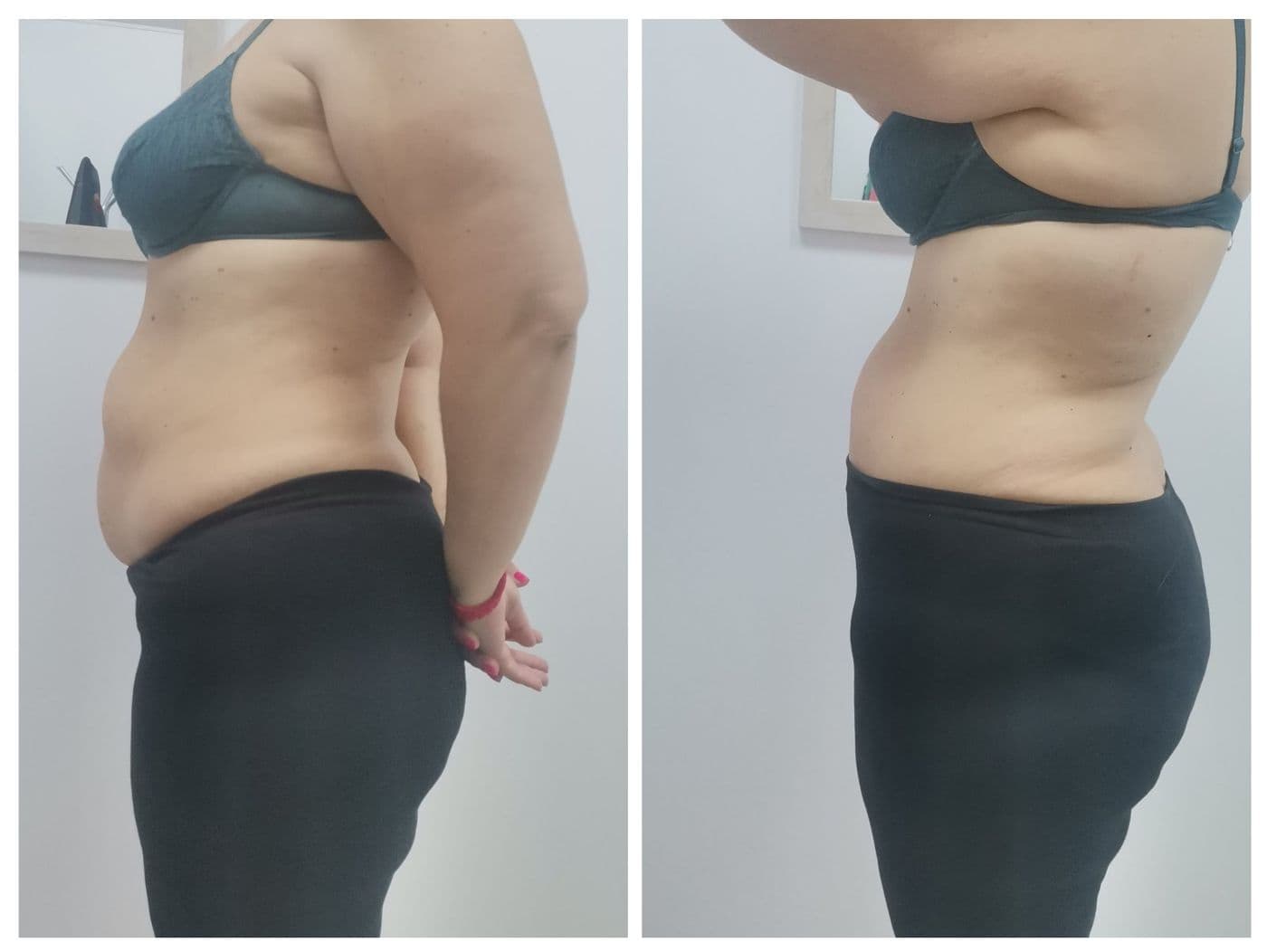 Sculpt Pro и пресотерапия: преди и след