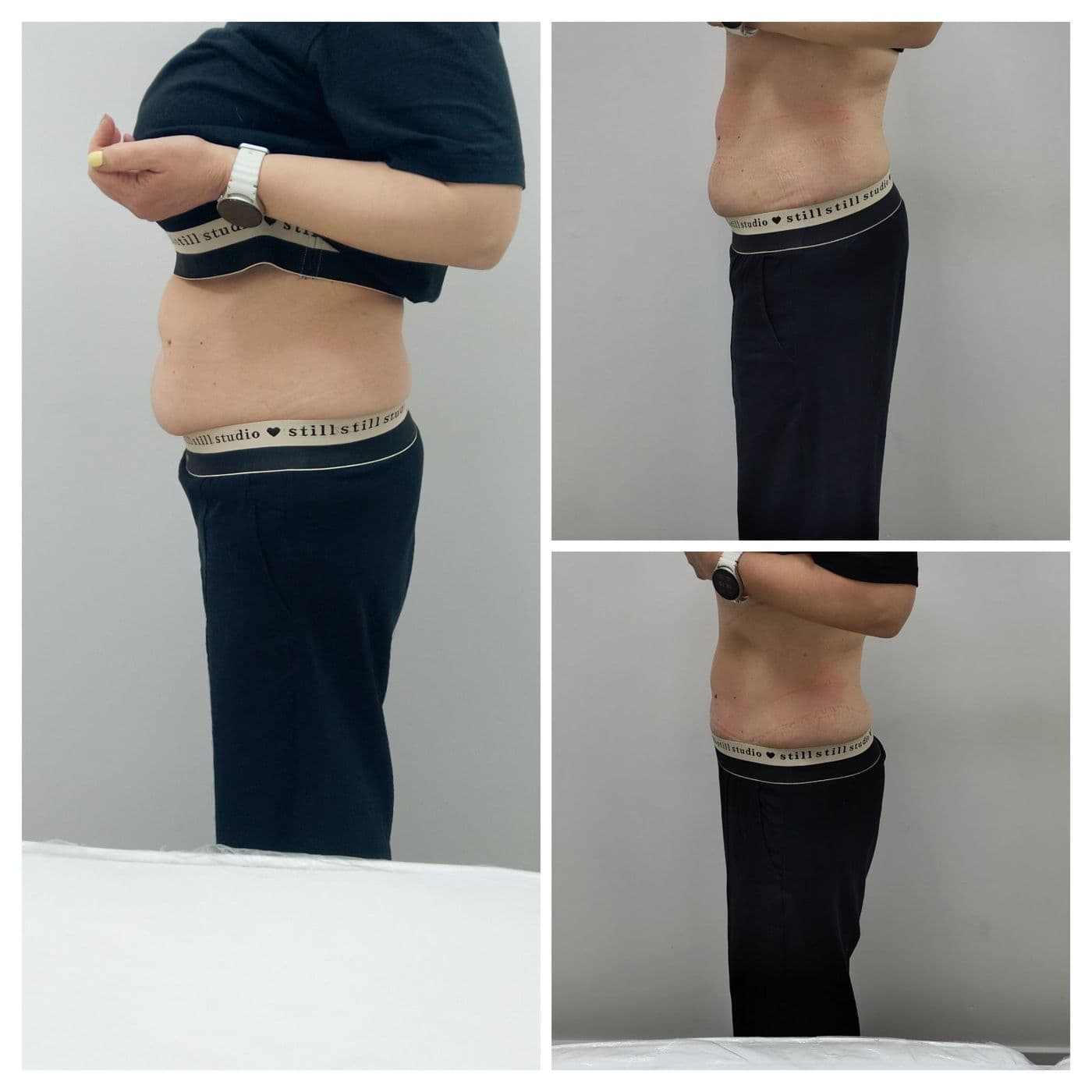 Sculpt Pro и пресотерапия: преди и след