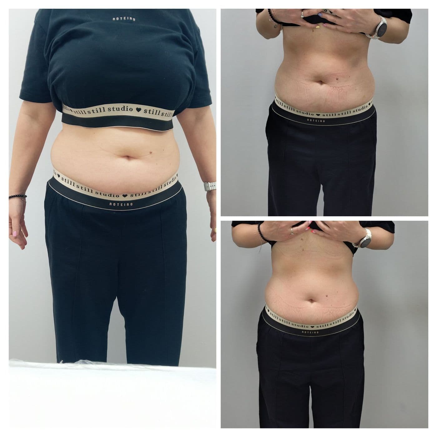 Sculpt Pro и пресотерапия: преди и след