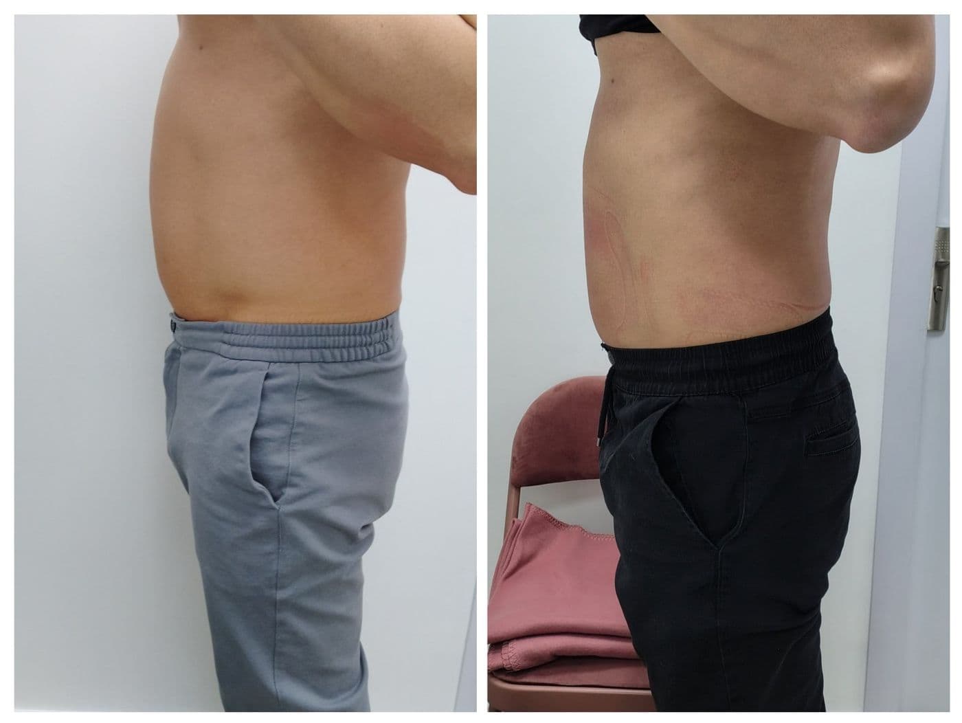 Sculpt Pro и пресотерапия: преди и след