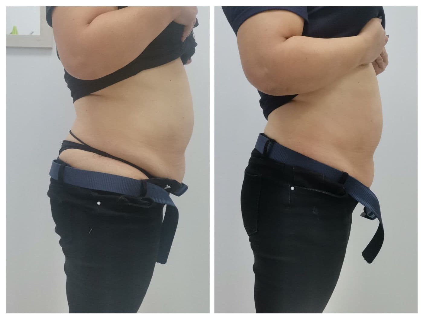 Sculpt Pro и пресотерапия: преди и след