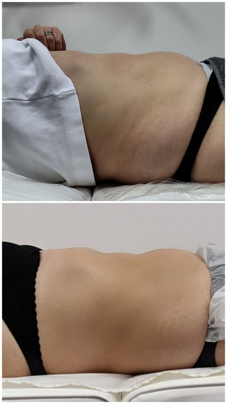 Sculpt Pro и пресотерапия: преди и след
