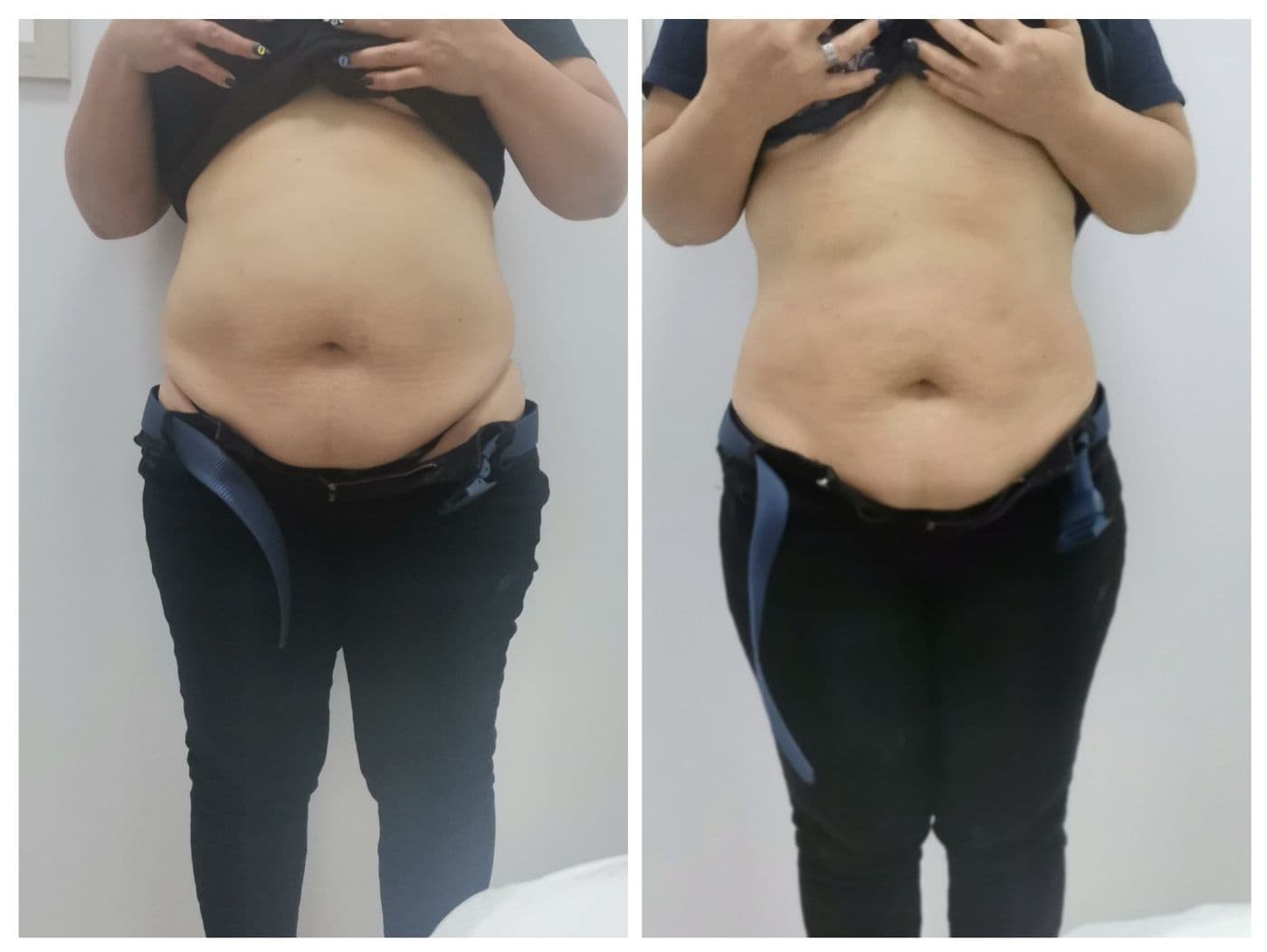 Sculpt Pro и пресотерапия: преди и след